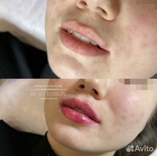 Увеличение губ, увлажнение 0,5мл, 1мл