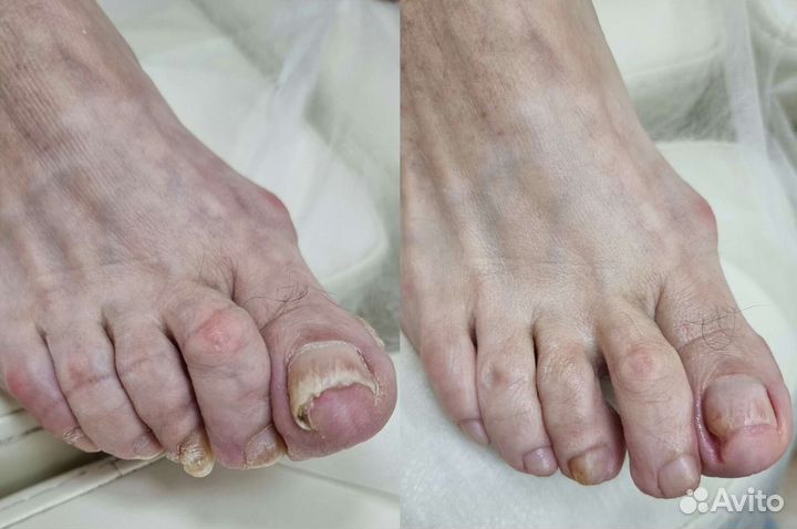 Медицинский педикюр подолог