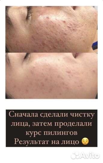 Косметолог чистка лица лечение акне