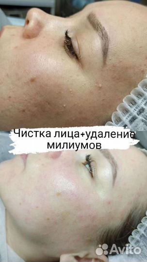 Косметологические процедуры за лицом