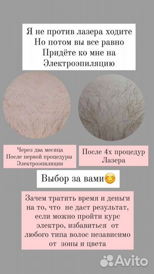 Электроэпиляция