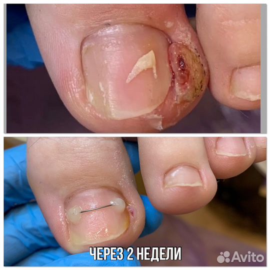 Педикюр,подолог,вросшие ногти