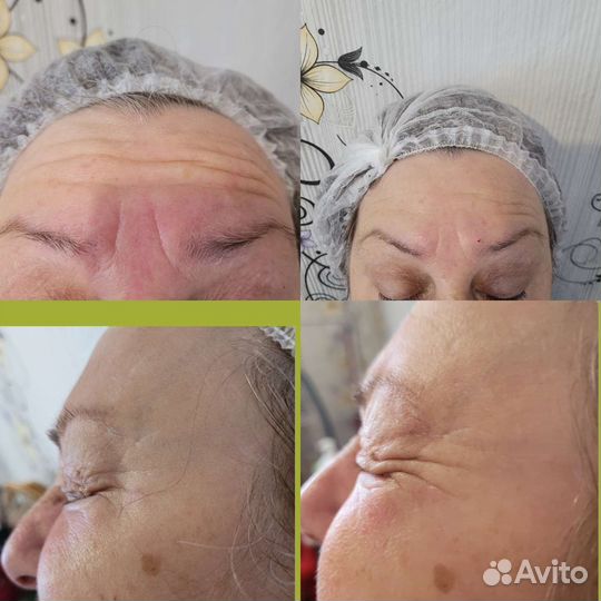 Релатокс, Ботокс