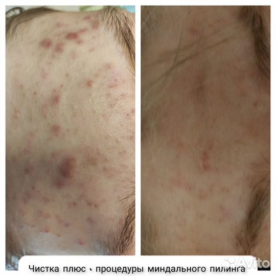 Косметолог чистка лица