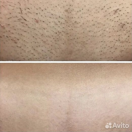 Лазерная эпиляция