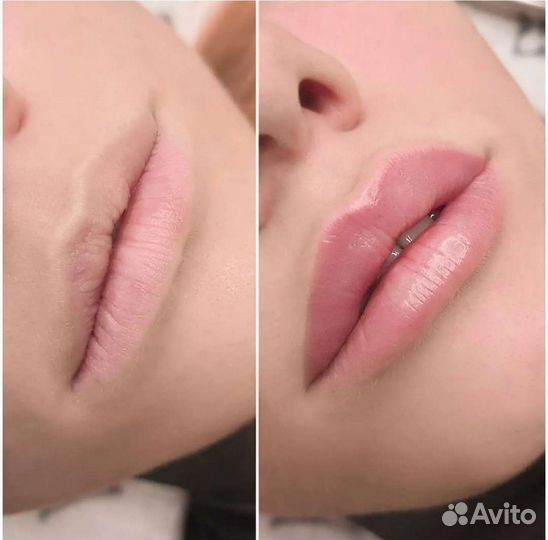 Увеличение губ