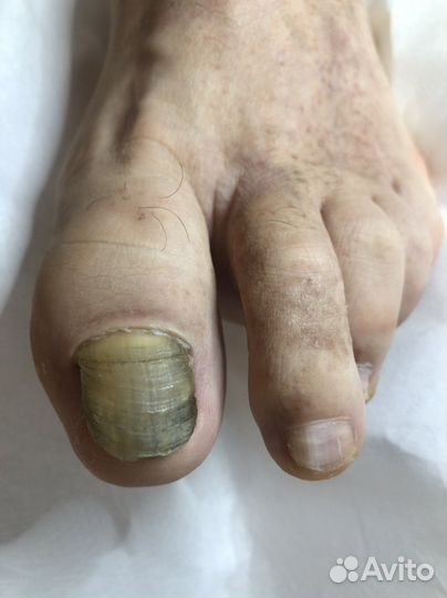 Педикюр Подология