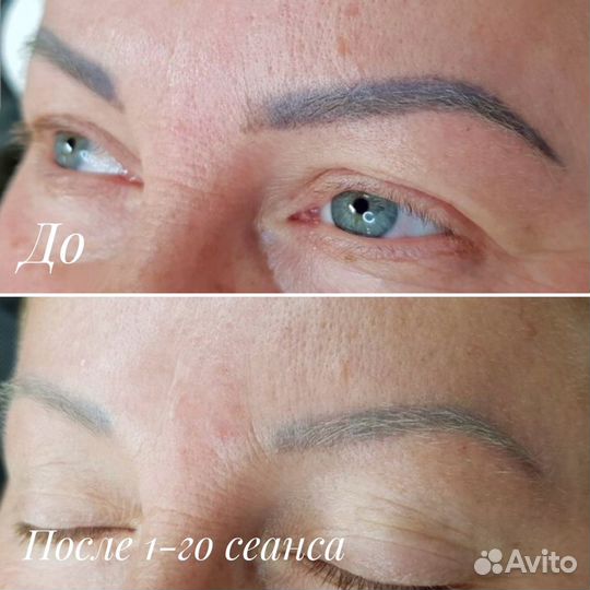 Удаление татуировок и татуажа