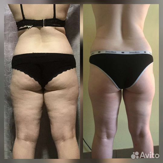 Антицеллюлитный массаж кавитация аппаратный