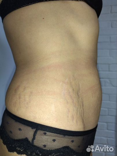 Похудение убираем целлюлит любой стадии. Аппарат