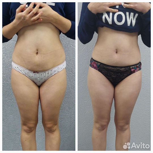 Коррекция фигуры - эффективное похудение