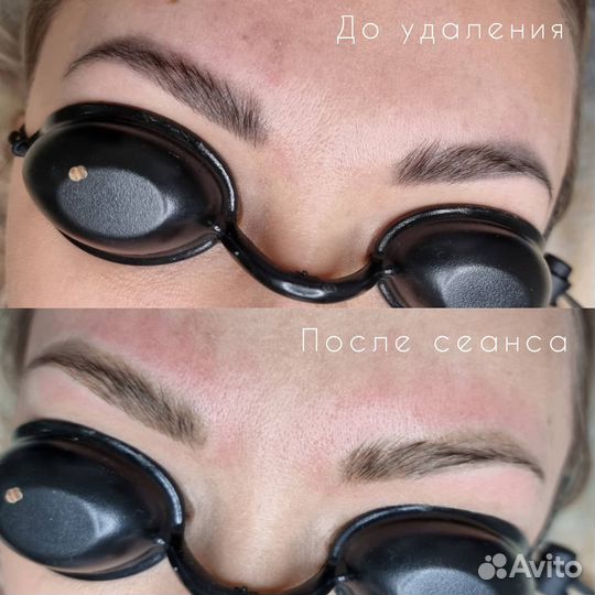 Удаление татуажа бровей/тату