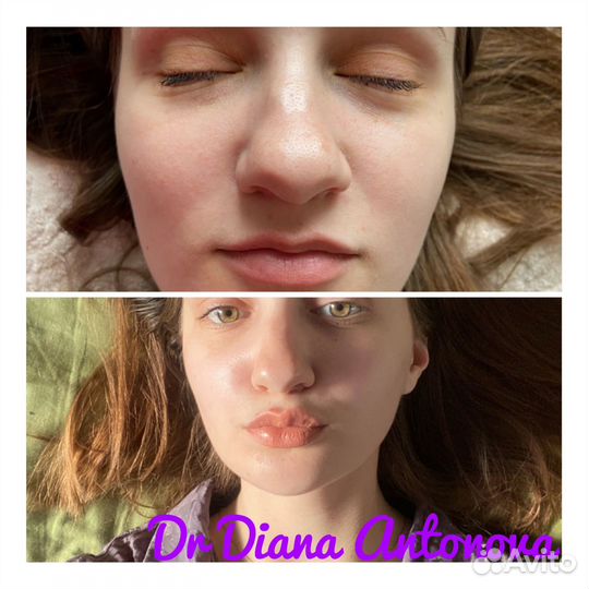 Увеличение губ