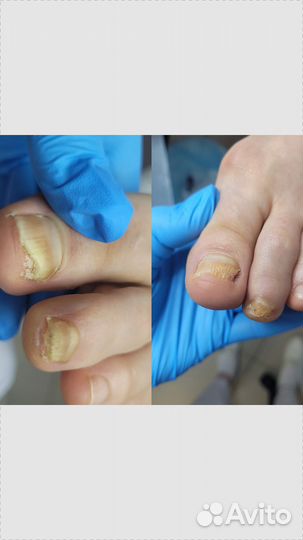 Педикюр подолог