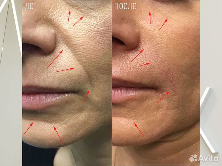 РФ - лифтинг / RF лифтинг лица и тела