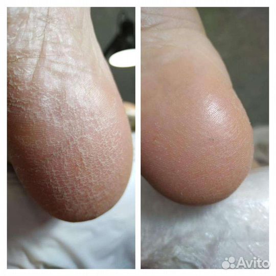 Медицинский педикюр/Подолог