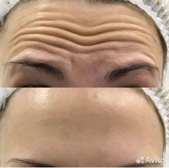 Биоревитализация