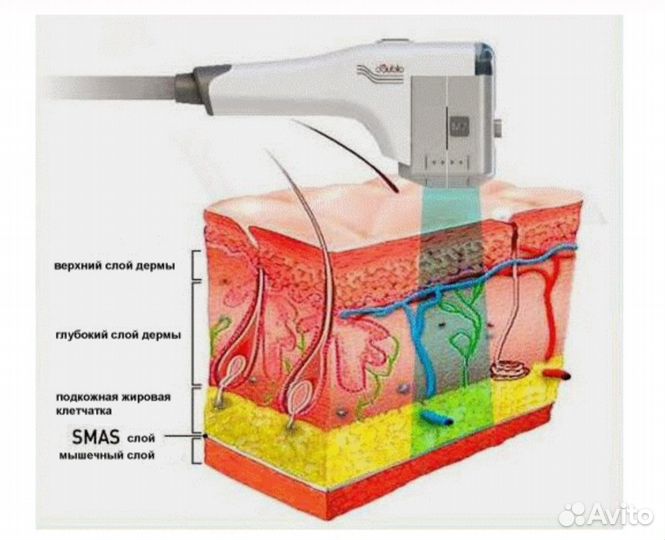 SMAS лифтинг