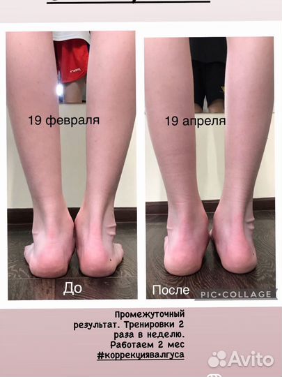 Коррекция вальгуса и осанки детям и взрослым