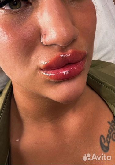 Увеличение губ