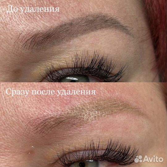 Удаление татуажа