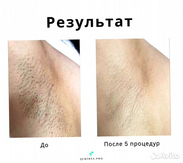 Диодный лазер люминес Max’One 1200вт