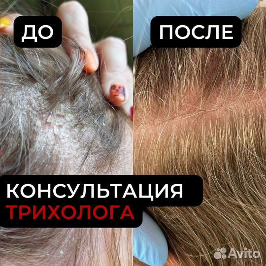 Консультация трихолога онлайн