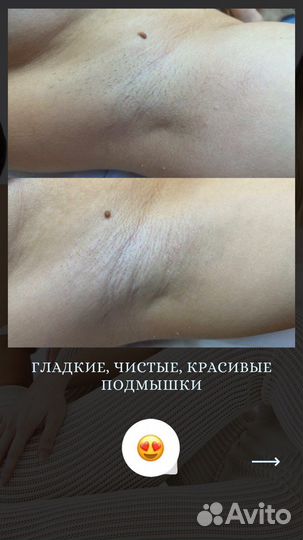 Электроэпиляция
