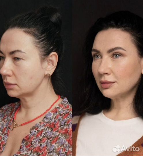 Ботокс для лица и тела/ Фулл Фейс