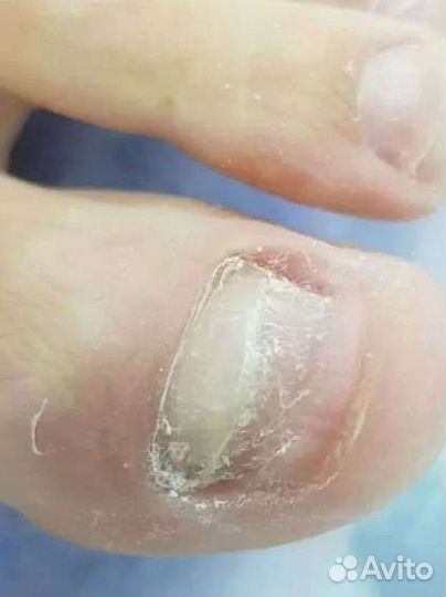 Медицинский педикюр. Подолог. Выезд на дом
