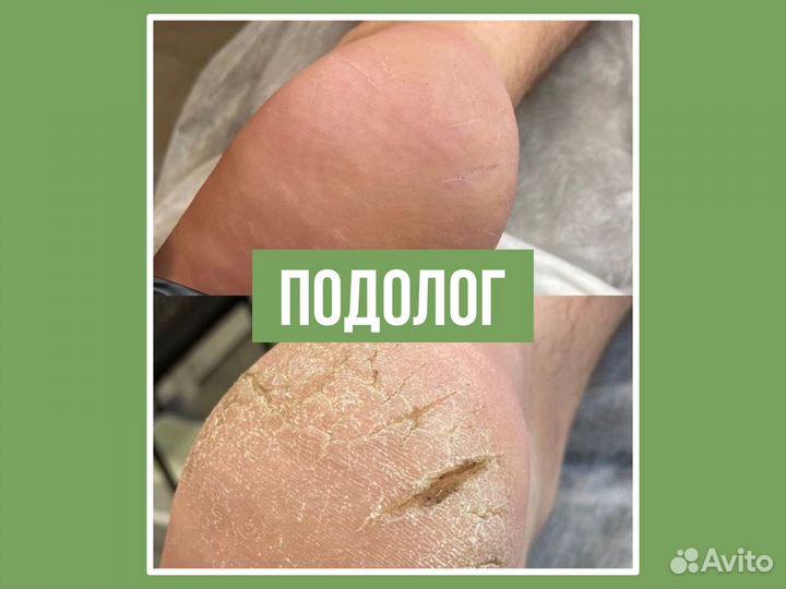 Подолог Педикюр Титановая нить