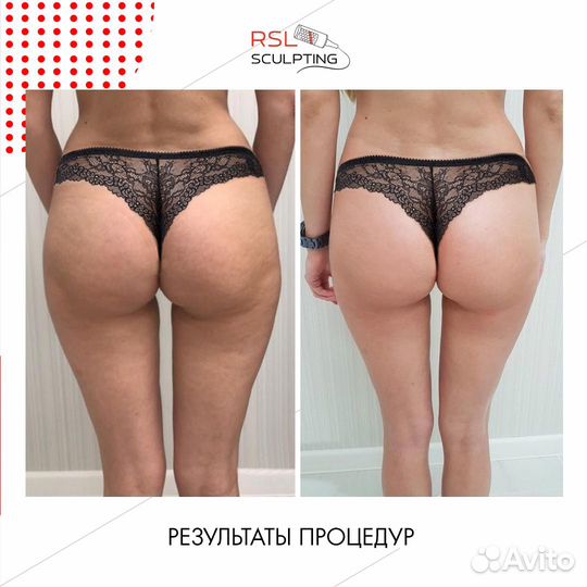 Rsl скульптурирование на аппарате beautylizer