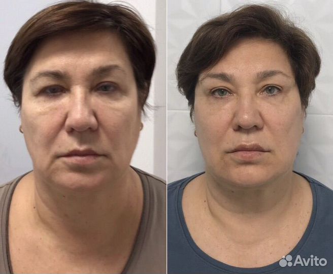 Эластичная подтяжка лица