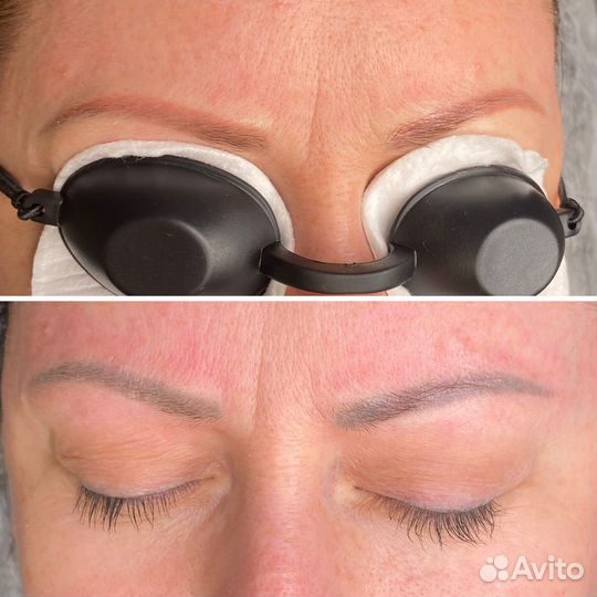 Лазерное удаление татуажа