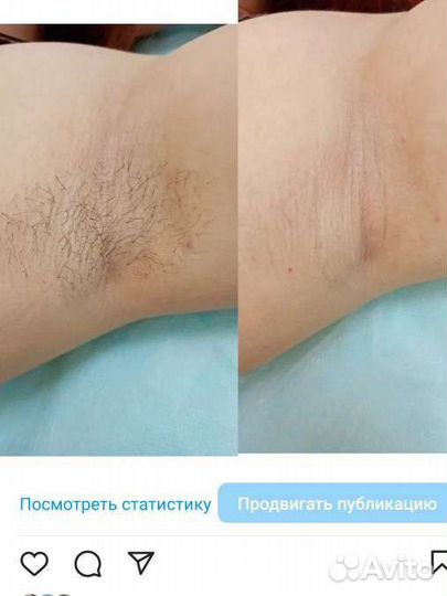 Шугаринг на дому сахарной пастой