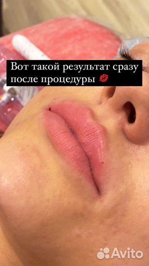 Ищу моделей на ботокс,увеличение губ,филеры, мезо