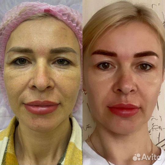 Холодная плазма