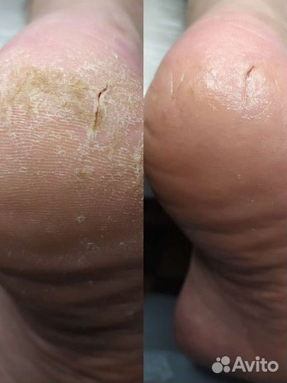 Подолог, педикюр