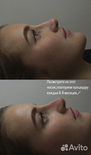 Увеличение губ