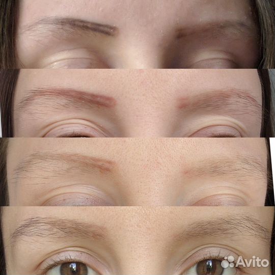 Удаление татуажа и тату лазером требуются модели