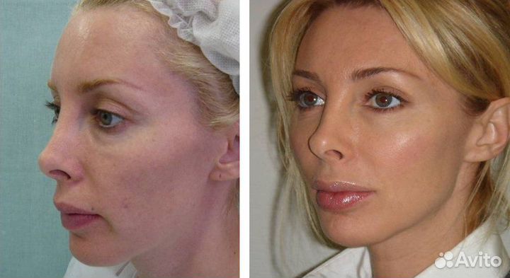 Модели на Кислородное Омоложение Брылей