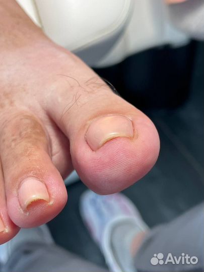 Вросший ноготь педикюр