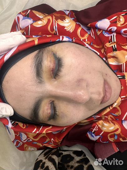 Блефоропластика, липофилинг