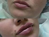 Бьютификация губ