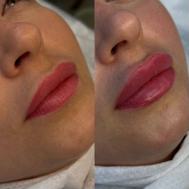 Модели. Контурная пластика губ
