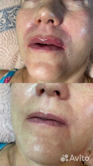 Увеличение губ