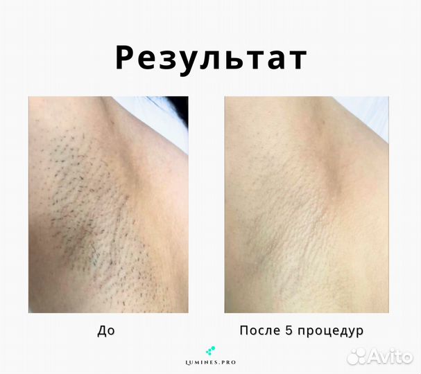 Аппарат для эпиляции Lumines Max’One 1200W