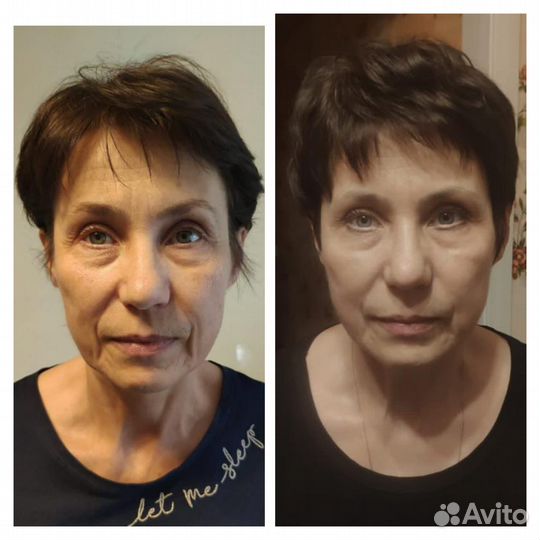 Смас-лифтинг