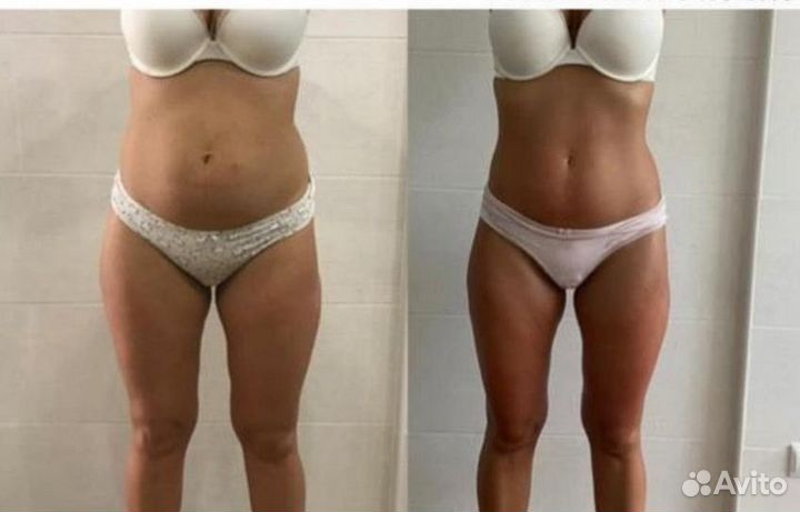 Гидромассаж (подводно-вакуумный массаж)