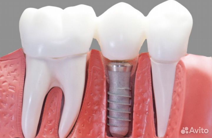 Импланты зубные